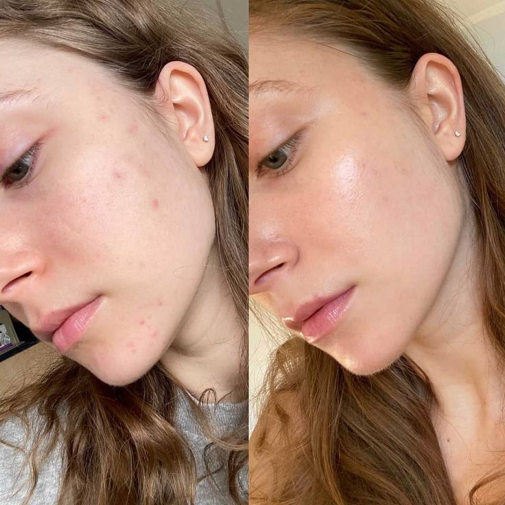 10% Niacinamide Serum